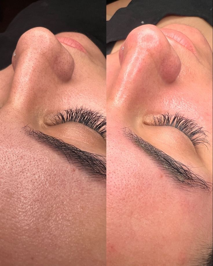 Beauty Bar by Mahshid – BB Glow und Microneedling